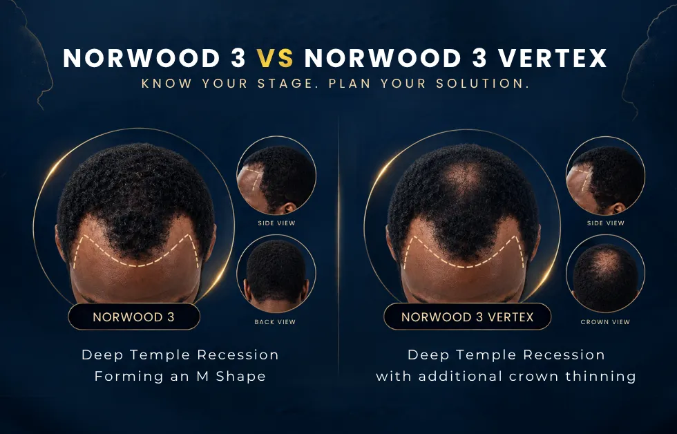 Norwood 3 vs 3 Vertex, Norwood 3 Vertex, Crown Hair Loss, Hair Loss Classification