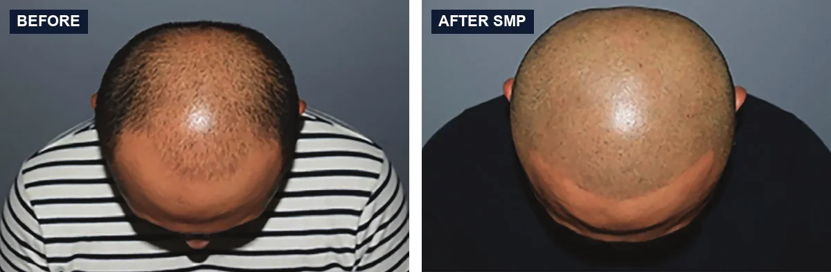 Top view of a man's head before and after scalp micropigmentation, with a bald top on the left and an even shaved-hair look on the right