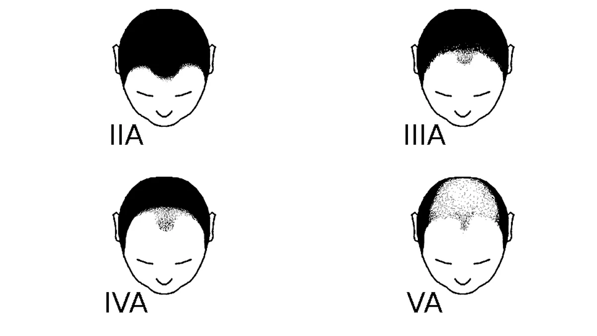 Dessins des variantes de classe A de l'échelle de Norwood, de IIA à VA, où la ligne frontale recule depuis l'avant sans zone dégarnie au sommet du crâne