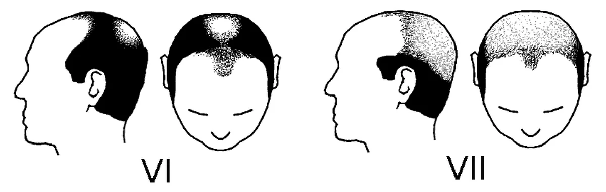 Two line drawings of a head from above: stage VI with a bare top and a full band at the sides, stage VII with a narrower band set lower on the head
