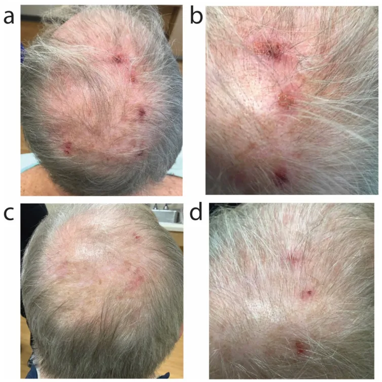 Four close-up views of the crown of a man with short grey hair, showing scattered red and crusted spots among the hairs