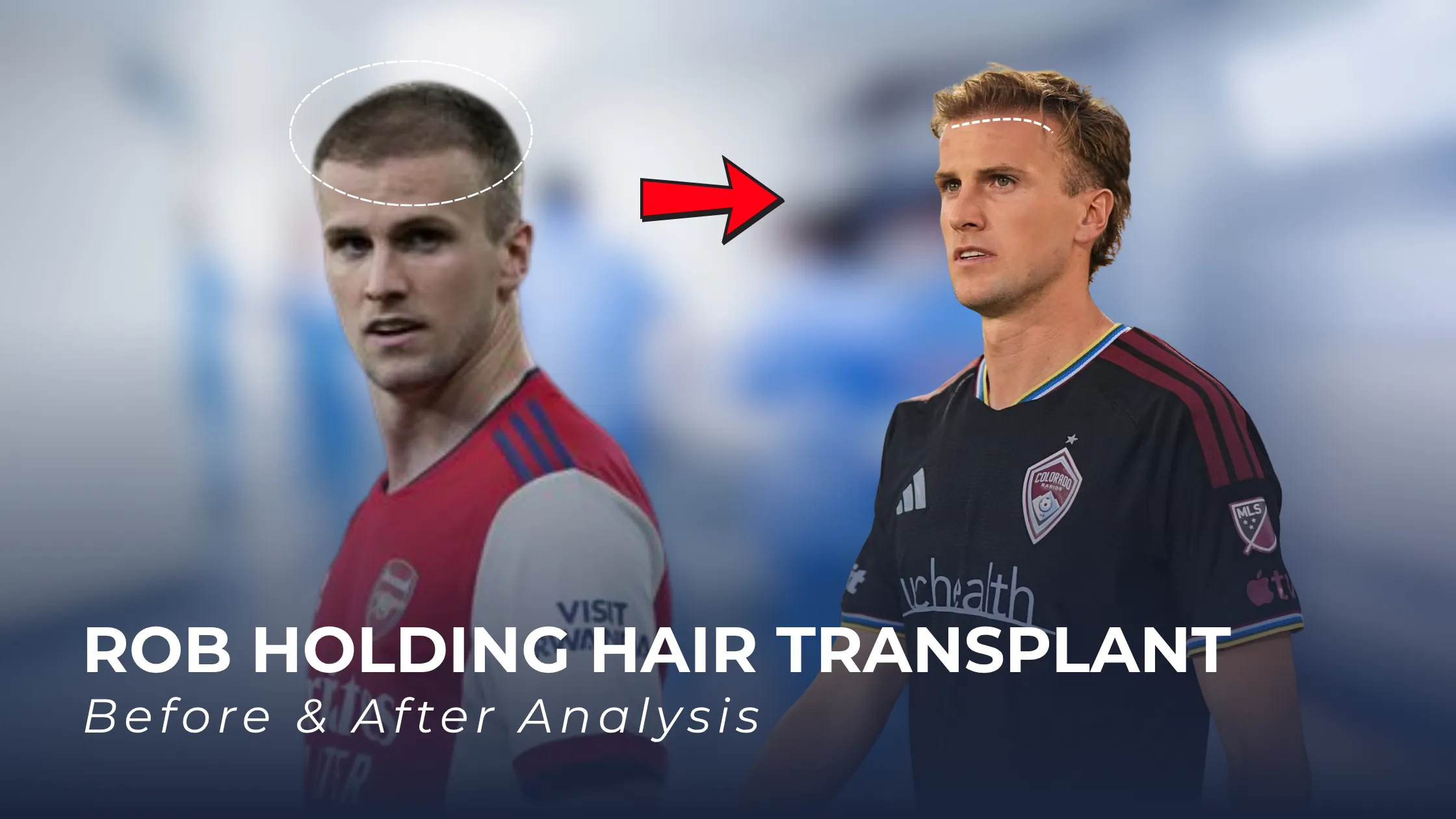 Rob Holding hair transplant before after, Rob Holding hairline transformation, Rob Holding hair loss analysis, Rob Holding frontal hairline, football player hair transplant, hair transplant results