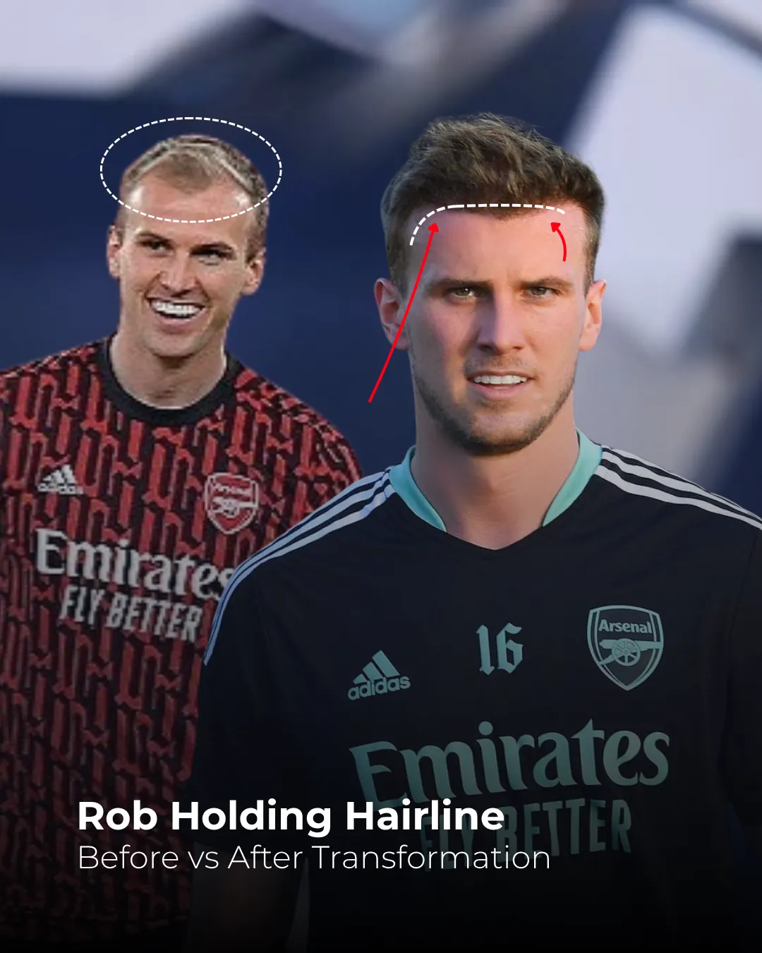 Rob Holding hairline recession, Rob Holding receding hairline, Rob Holding hair transplant analysis, Rob Holding temple recession, Rob Holding hairline repair, celebrity hair transplant