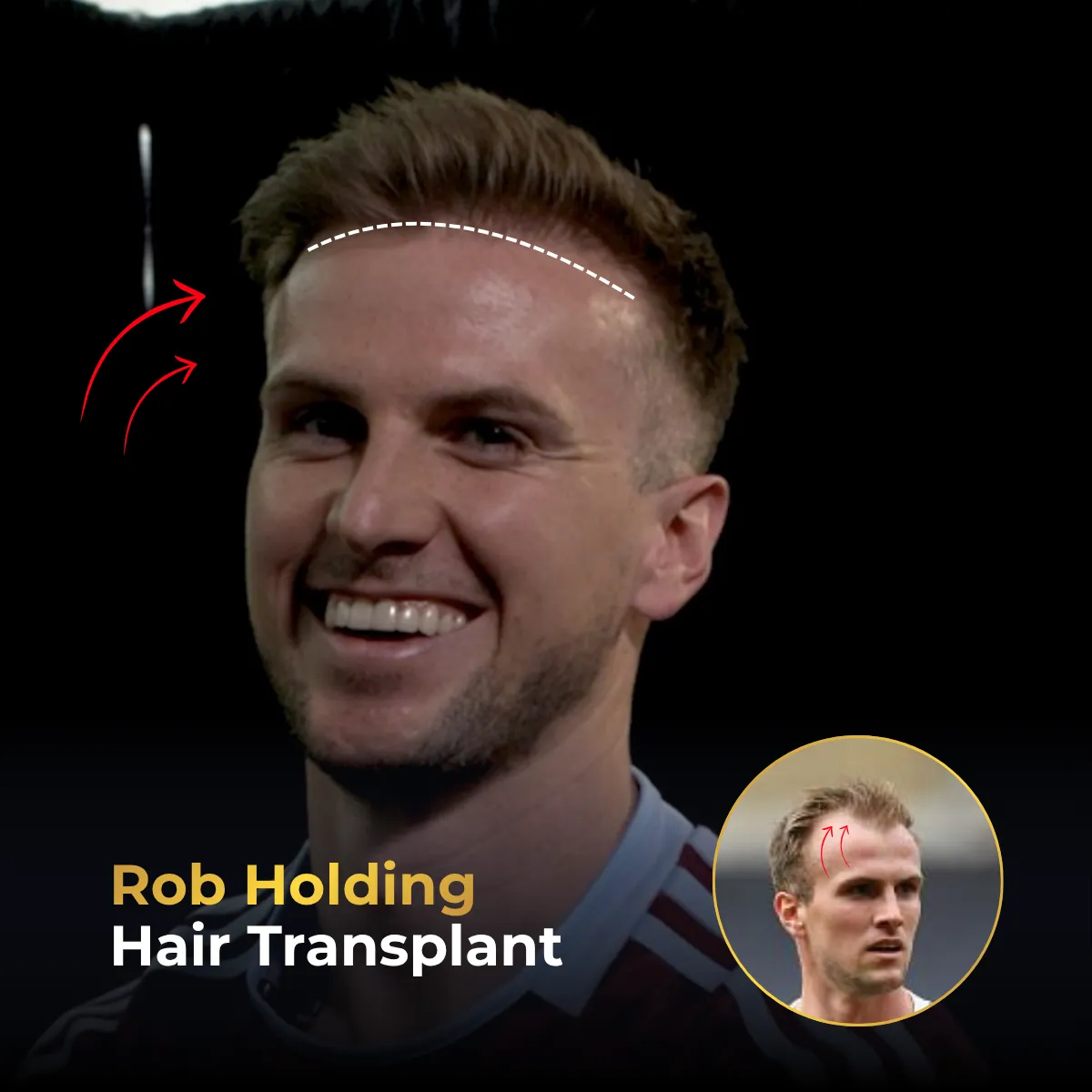 Rob Holding hairline design, Rob Holding graft extraction plan, Rob Holding consultation analysis, Rob Holding donor area analysis, hair transplant planning, Turkey Hair Center