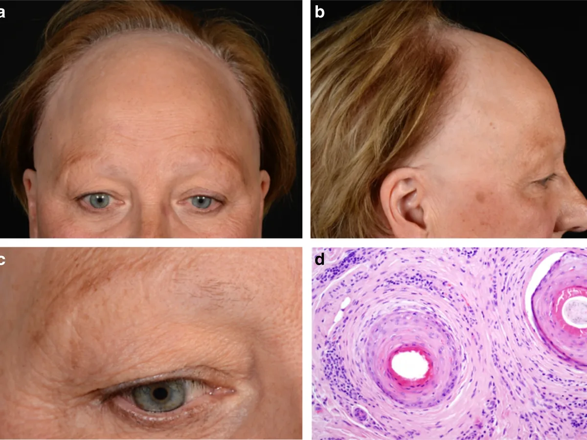 Clinical photos of frontal fibrosing alopecia showing a receded frontal hairline, hair loss at the temples and thinned eyebrows, with a microscope image of two hair follicles
