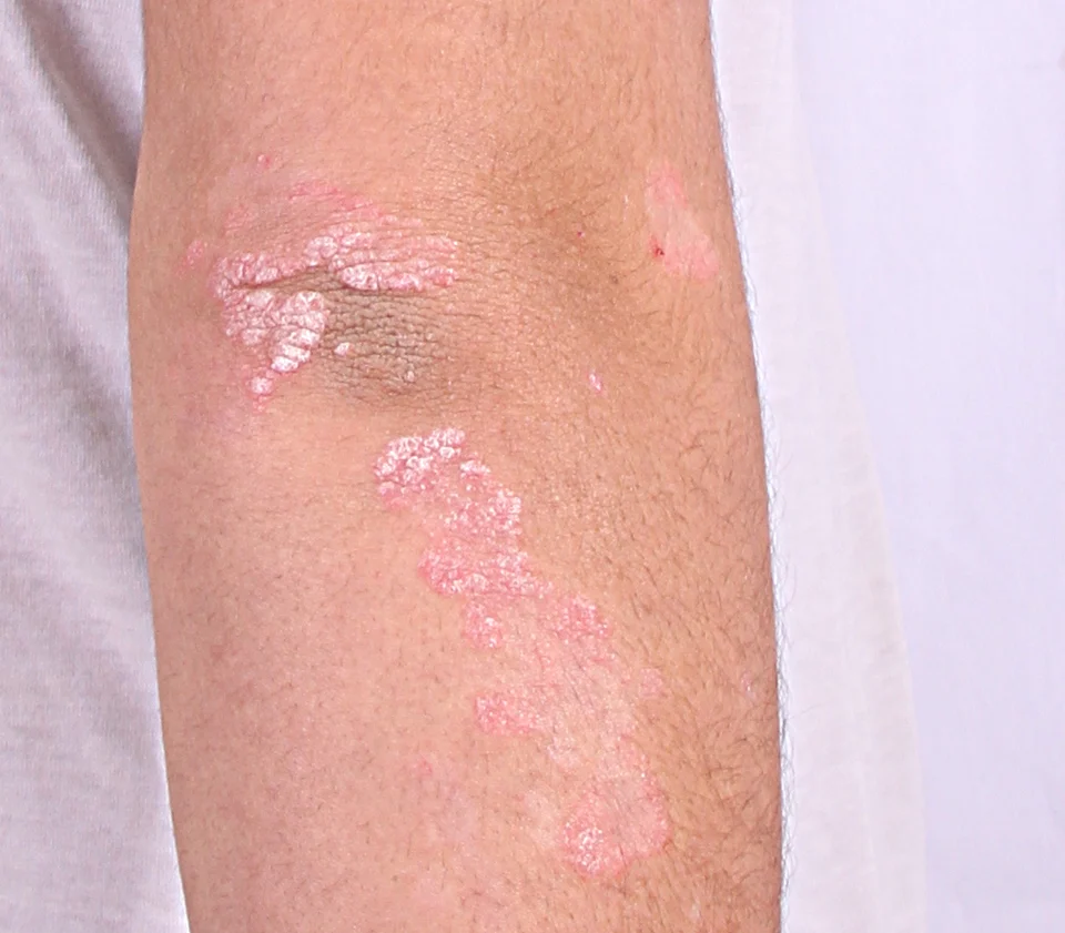 Silver-white scaly plaques of psoriasis on the outer elbow and forearm
