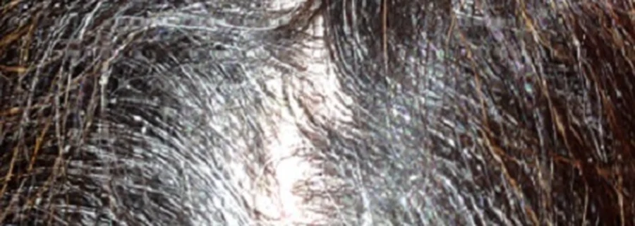 White psoriasis scale along the parting of dark hair on the scalp