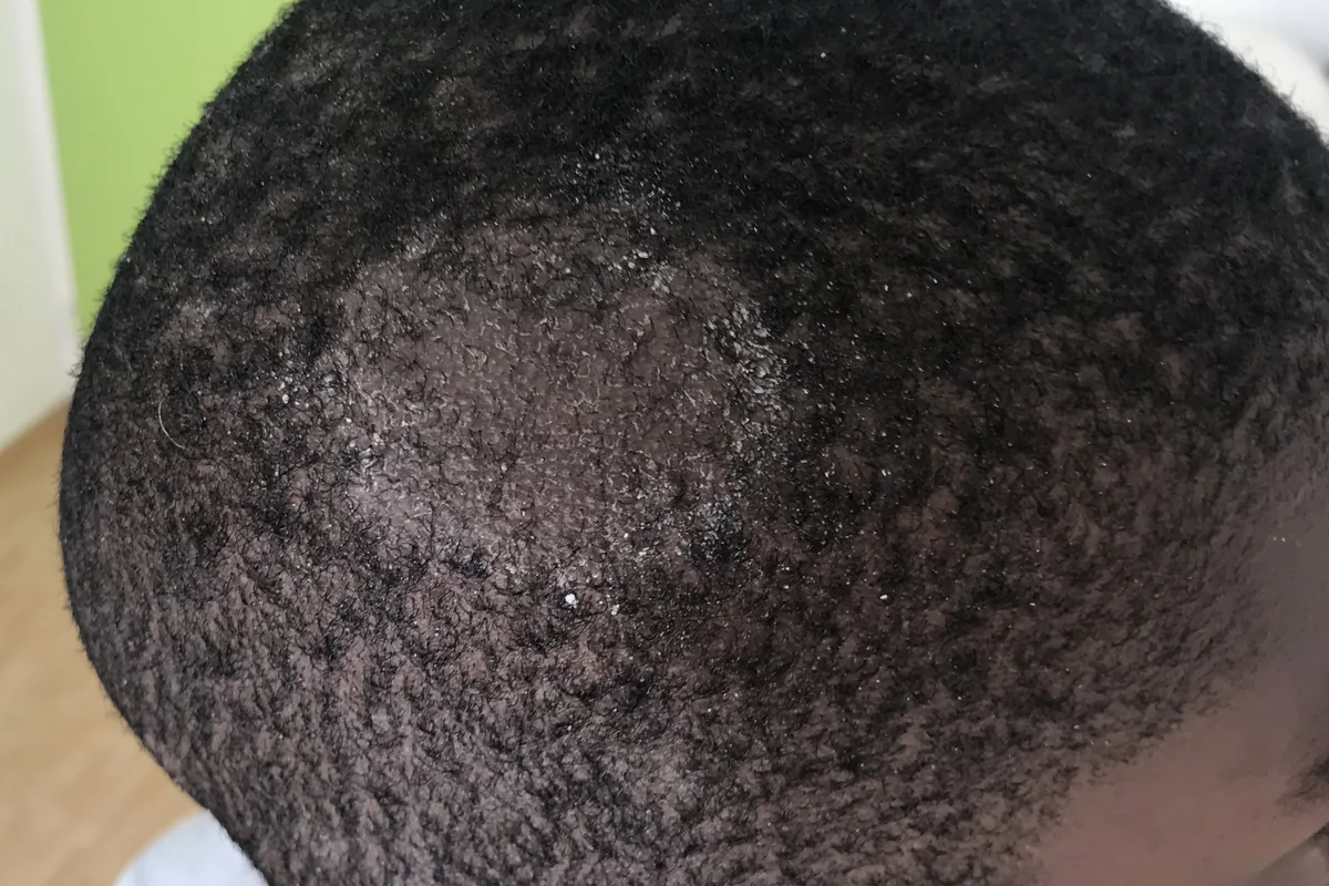 Round patch of short broken hairs with grey scale on the scalp of a child with short black hair