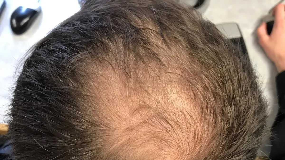 The top of a person's head seen from above, with dark hair thinning over the crown and the scalp showing through