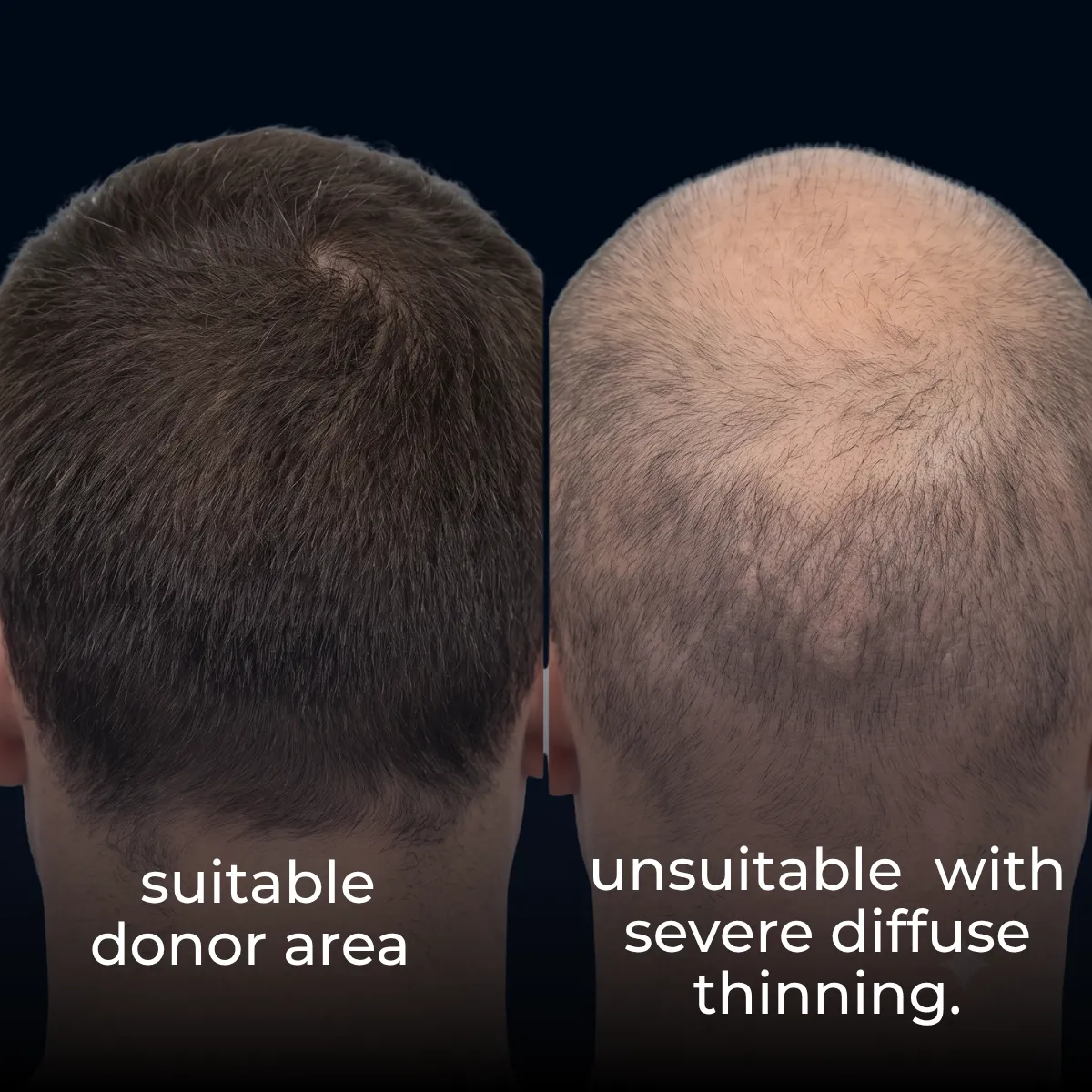 How Much Is Hair Replacement? Turkey Cost, Grafts, Packages & Results