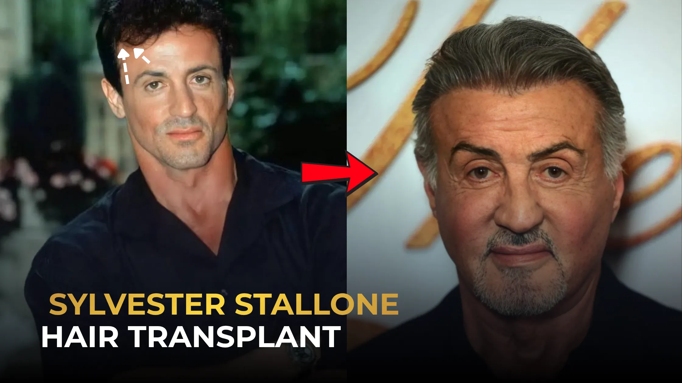 Sylvester Stallone Hair Transplant: Before & After