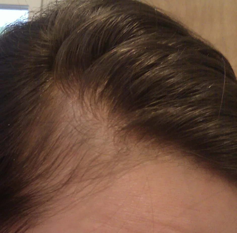 Thinning hair at the temple and front hairline of a woman with diffuse shedding