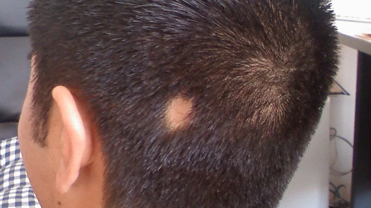 Back of a short-haired head seen from the side, with one smooth, round, hairless patch behind the ear on the scalp