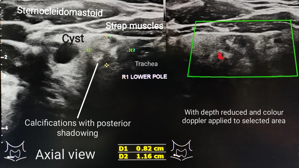Ultrasound image of the neck with labelled sternocleidomastoid and strap muscles, trachea, a cyst and a calcified nodule in the right lower thyroid pole