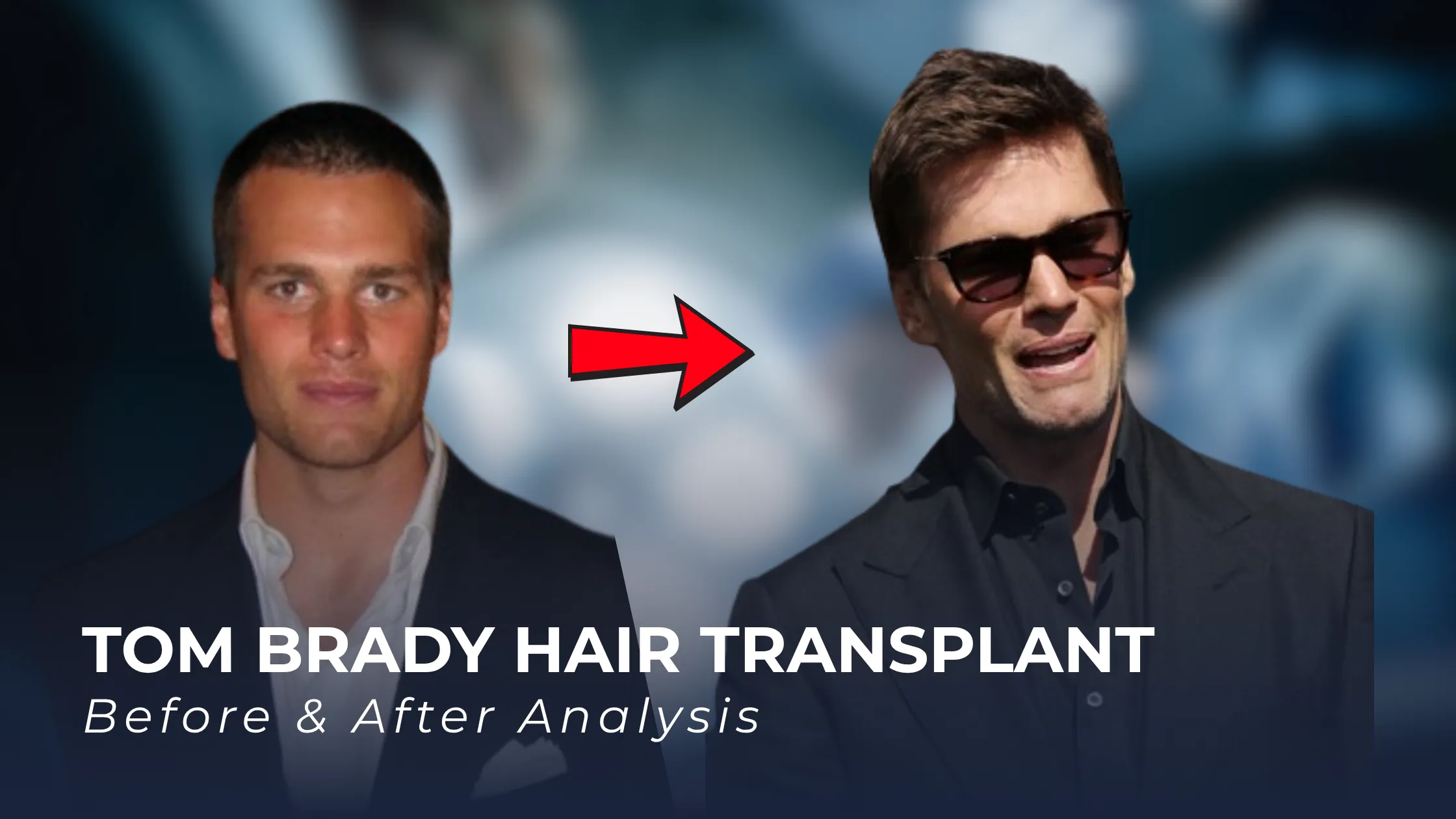 Tom Brady hair transplant, Tom Brady before after, Tom Brady hairline analysis, celebrity hair transplant, hair density change, hair restoration analysis