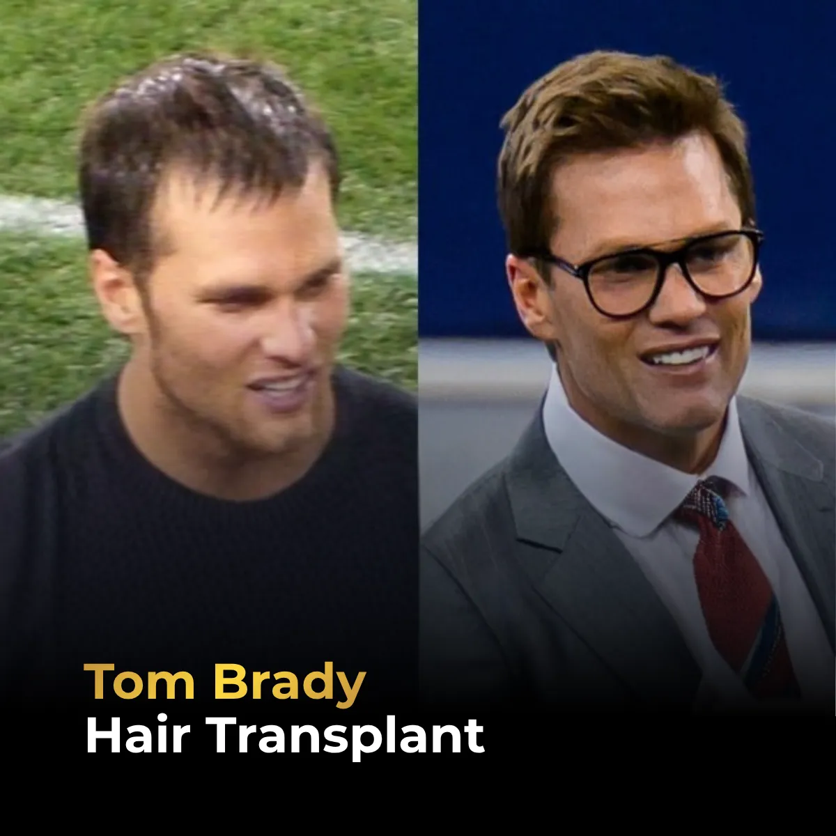 Tom Brady hairline analysis, Tom Brady hair transplant, Tom Brady hair loss, celebrity hair restoration, hairline change, hair transplant rumors