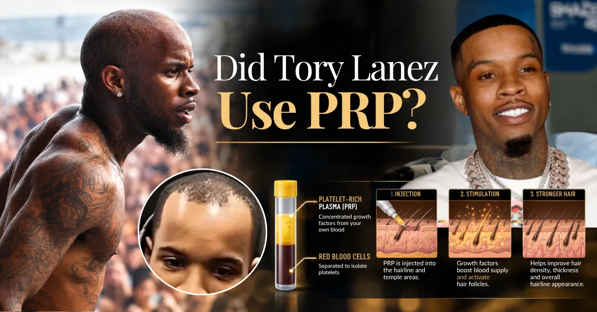 Tory Lanez Hair Transplant: Before & After, PRP & Facts