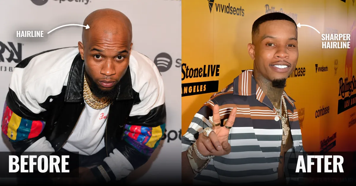 Tory Lanez Hair Transplant: Before & After, PRP & Facts