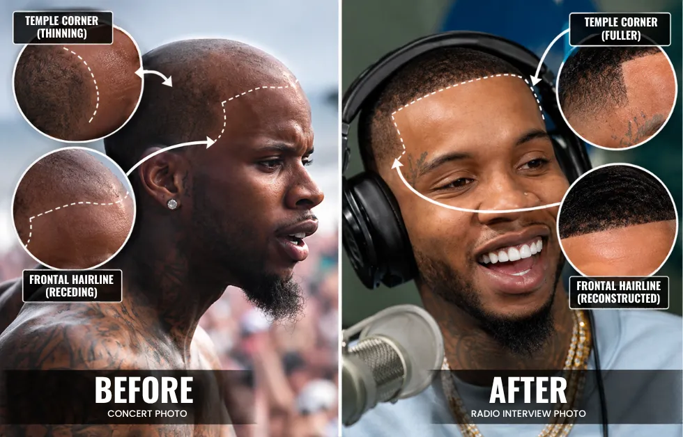 Tory Lanez Hair Transplant: Before & After, PRP & Facts