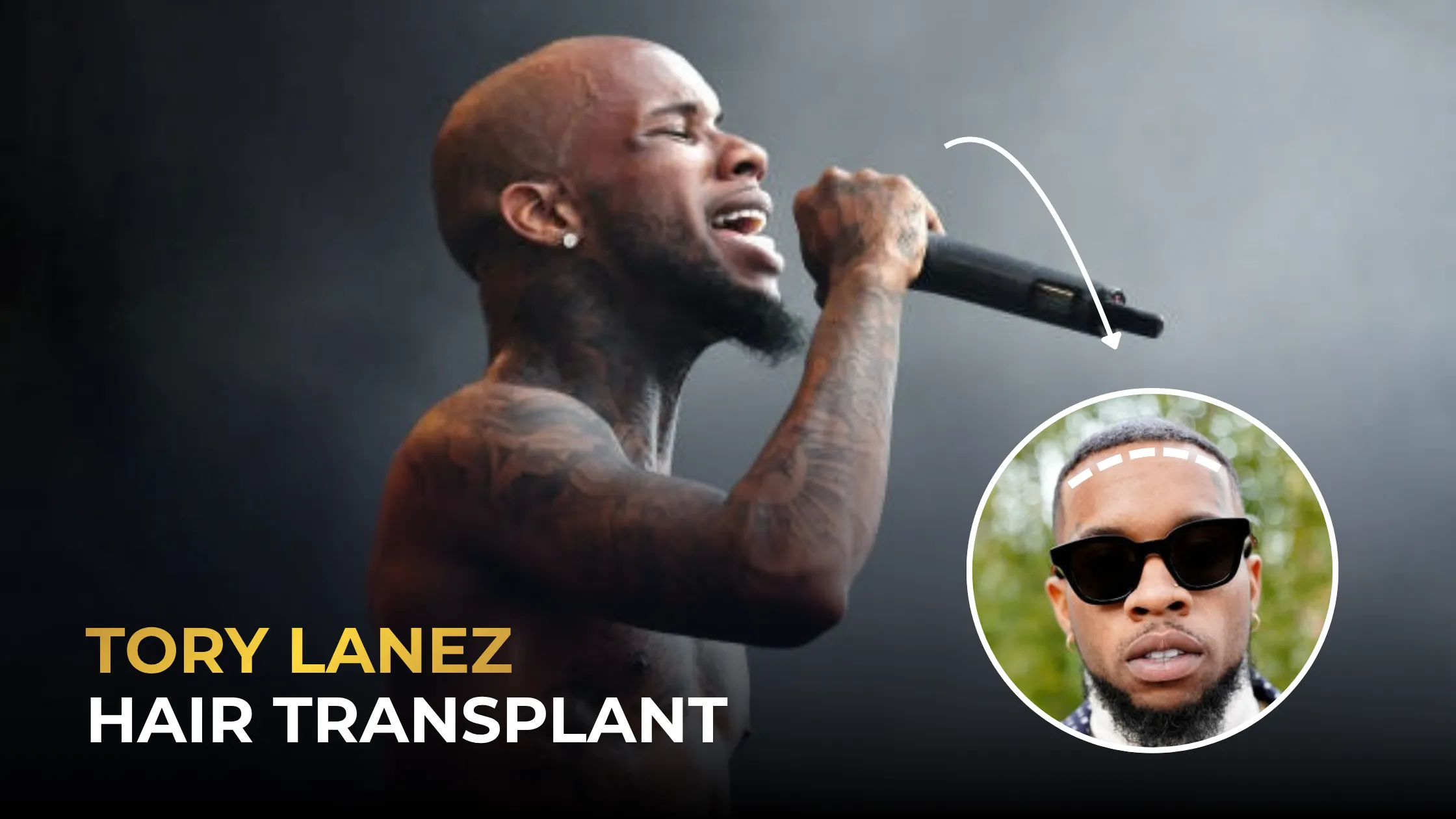 Tory Lanez Hair Transplant: Before & After, PRP & Facts