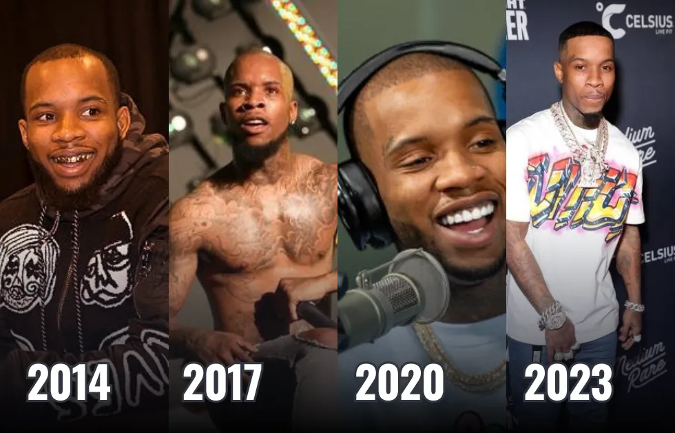 Tory Lanez Hair Transplant: Before & After, PRP & Facts
