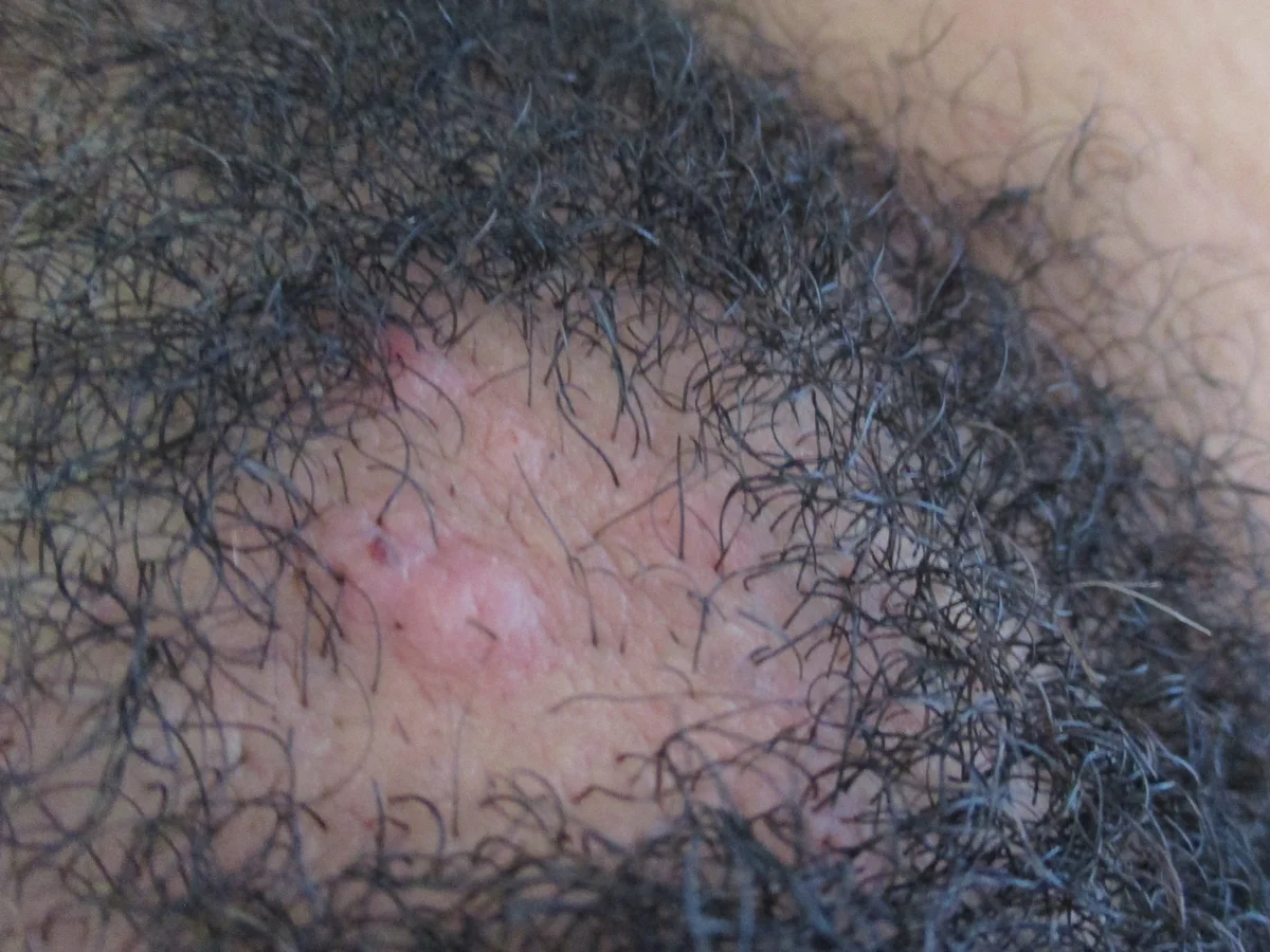 Close-up of a smooth, pink patch of missing hair inside a dark, curly beard