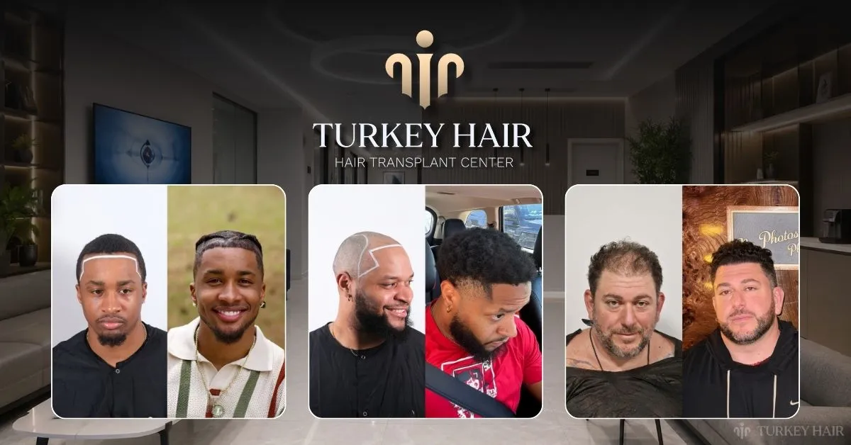 hair transplant journey Turkey, Turkey hair transplant timeline, hair transplant process, consultation to recovery timeline, hair transplant travel Turkey, hair transplant treatment process, Turkey hair transplant package, hair transplant journey guide, hair restoration Turkey, hair transplant patient journey