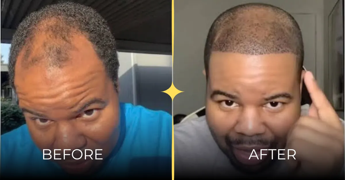 afro textured hair transplant, textured hair before after, black hair restoration results