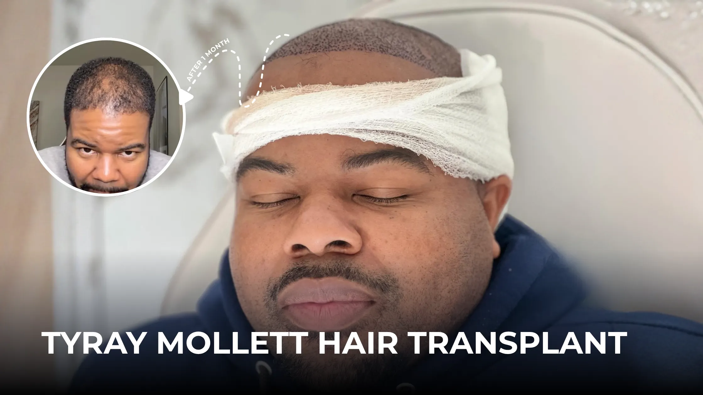 tyray mollett hair transplant cover, afro hair restoration guide, celebrity hair transplant story