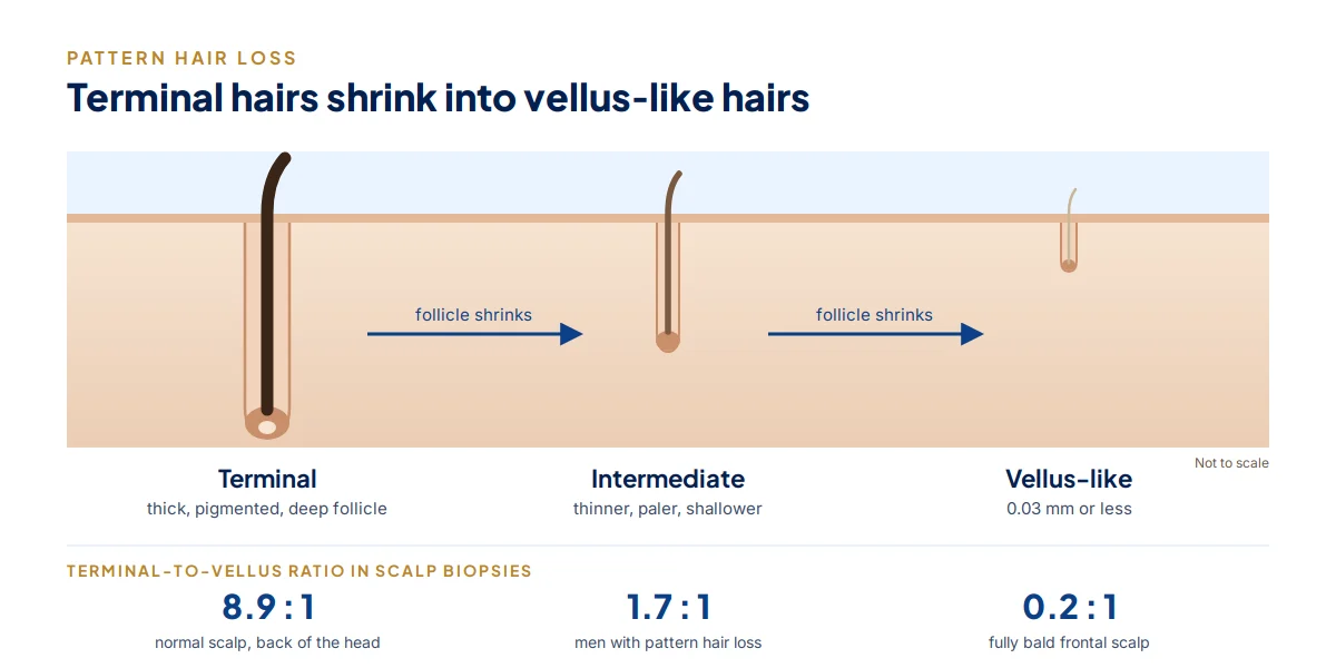 Diagram of a terminal hair shrinking through an intermediate stage into a vellus-like hair