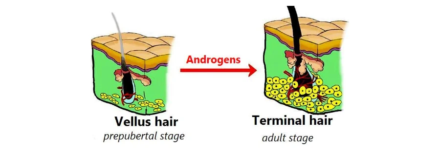 Diagram of skin cross-sections: a small vellus hair follicle before puberty and, after androgens act, a larger terminal hair follicle in the adult