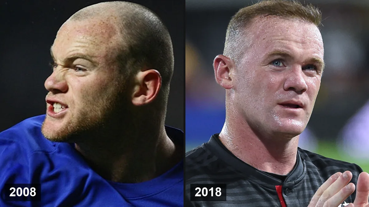 Greffe de cheveux de Wayne Rooney: Hair Transplant hair transplant analysis