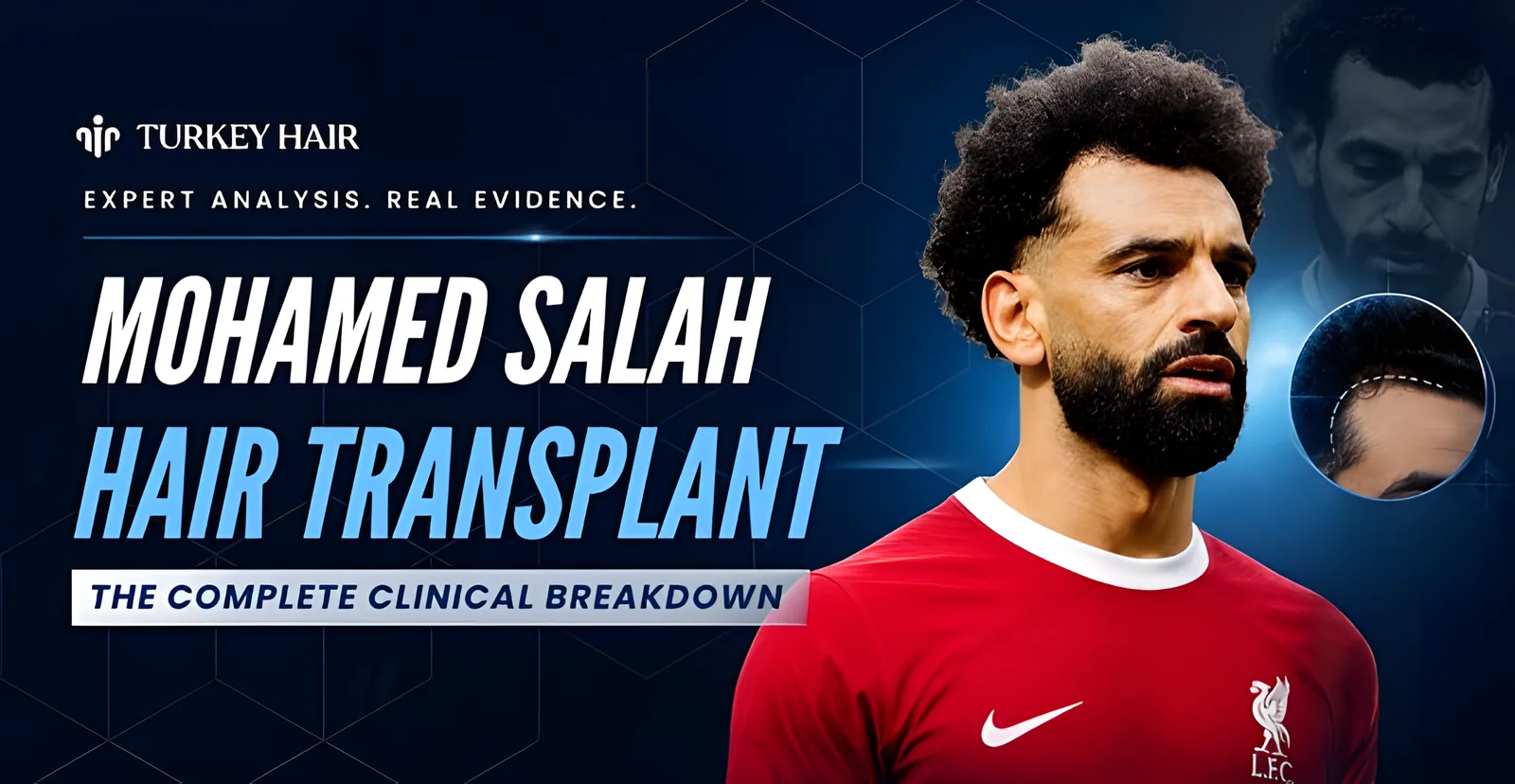 Did Mohamed Salah Get a Hair Transplant? Hairline & Before After Analysis