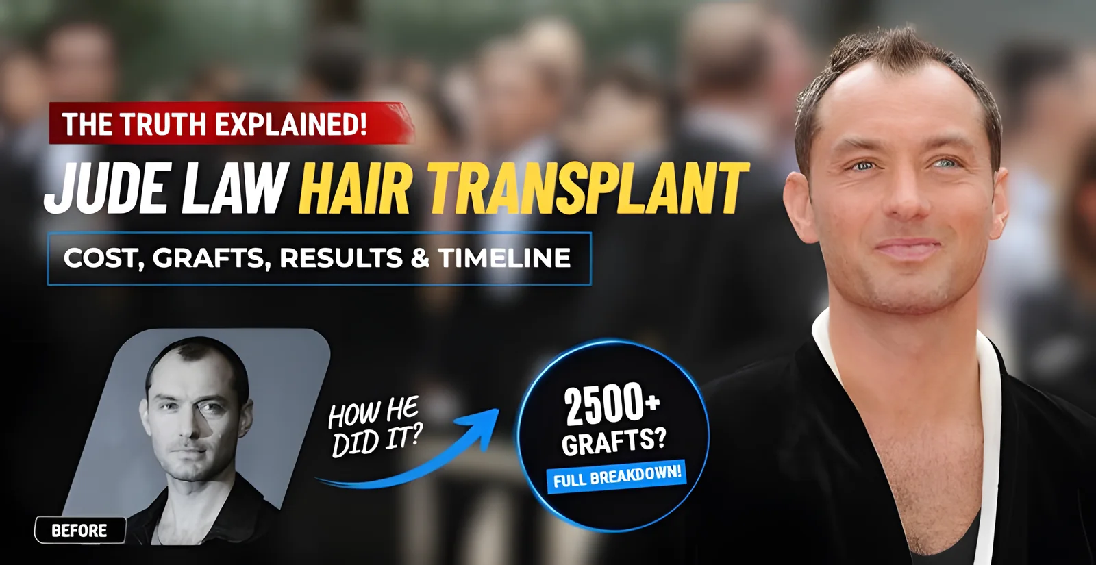 Jude Law Hair Transplant Analysis | Before, After & Hairline Timeline