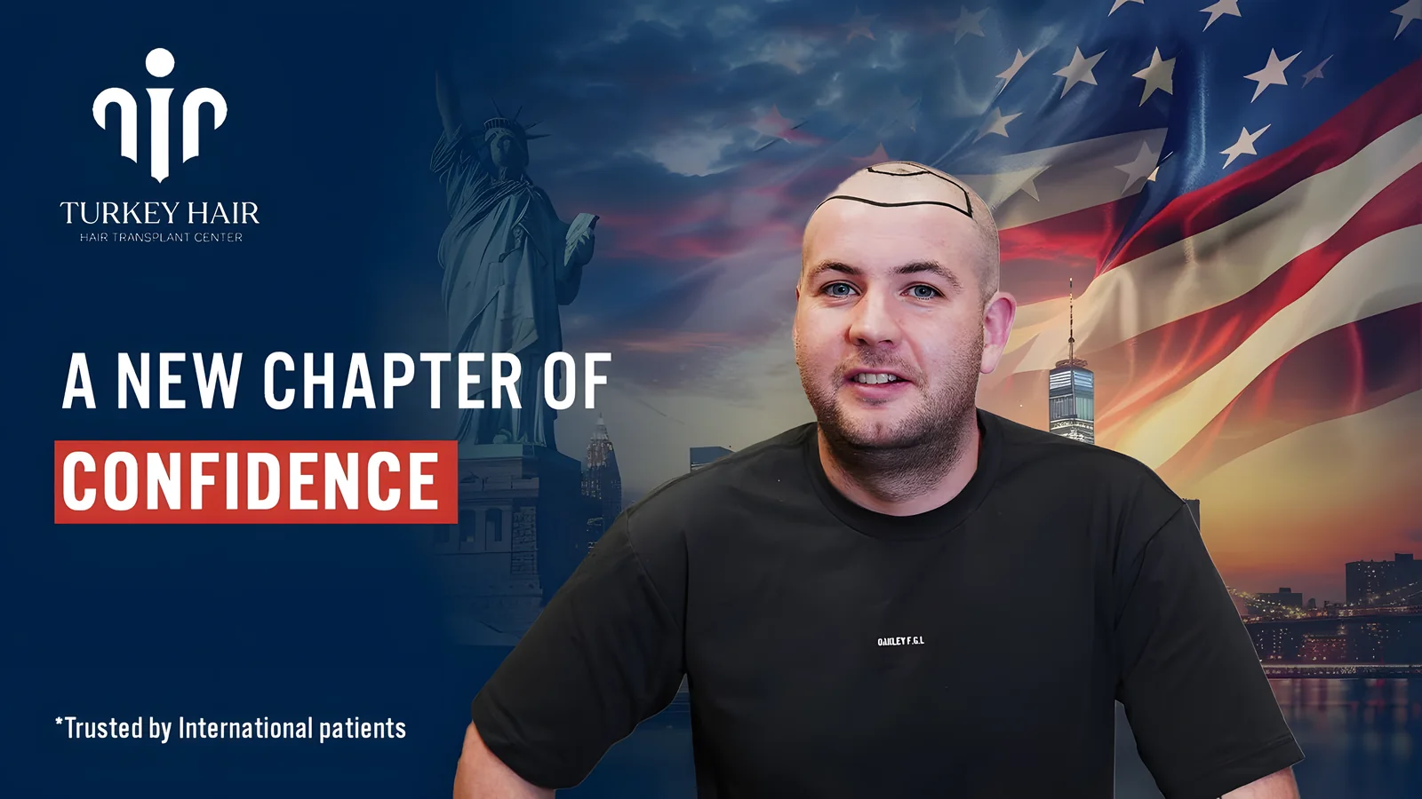 A Trusted Destination for USA Patients: Turkey Hair Transplant Center