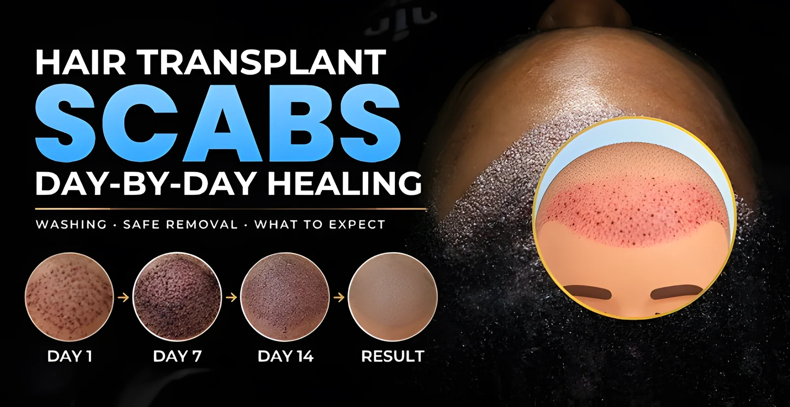 Hair Transplant Scabs: How Long Do They Last?