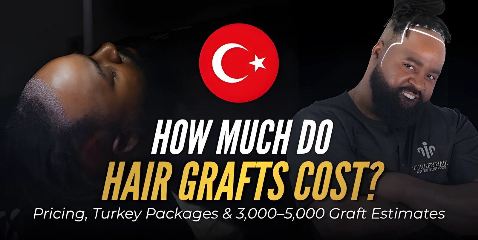 How Much Do Hair Grafts Cost? Price per Graft, FUE & Turkey Costs