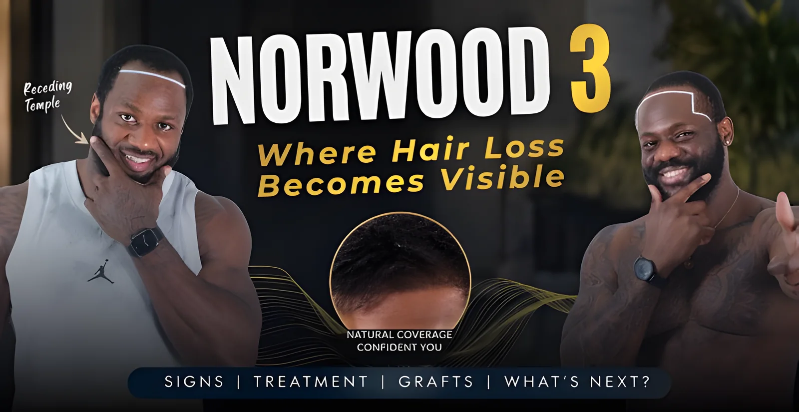 Norwood 3 Hair Loss Explained: Signs, Stages, Treatment & Hair Transplant