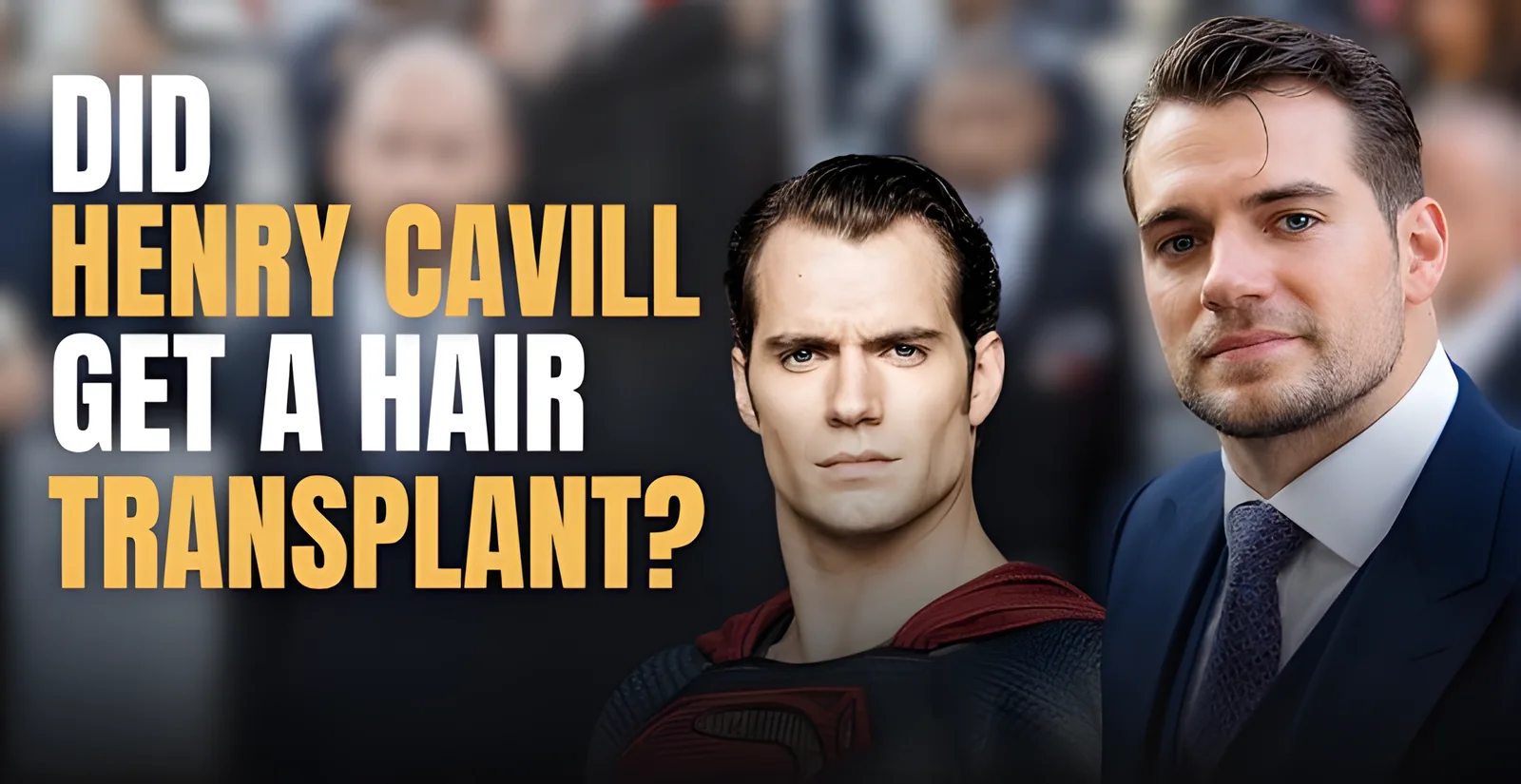 Henry Cavill Hair Transplant: Hairline, Temporal Peaks & Rumors Explained