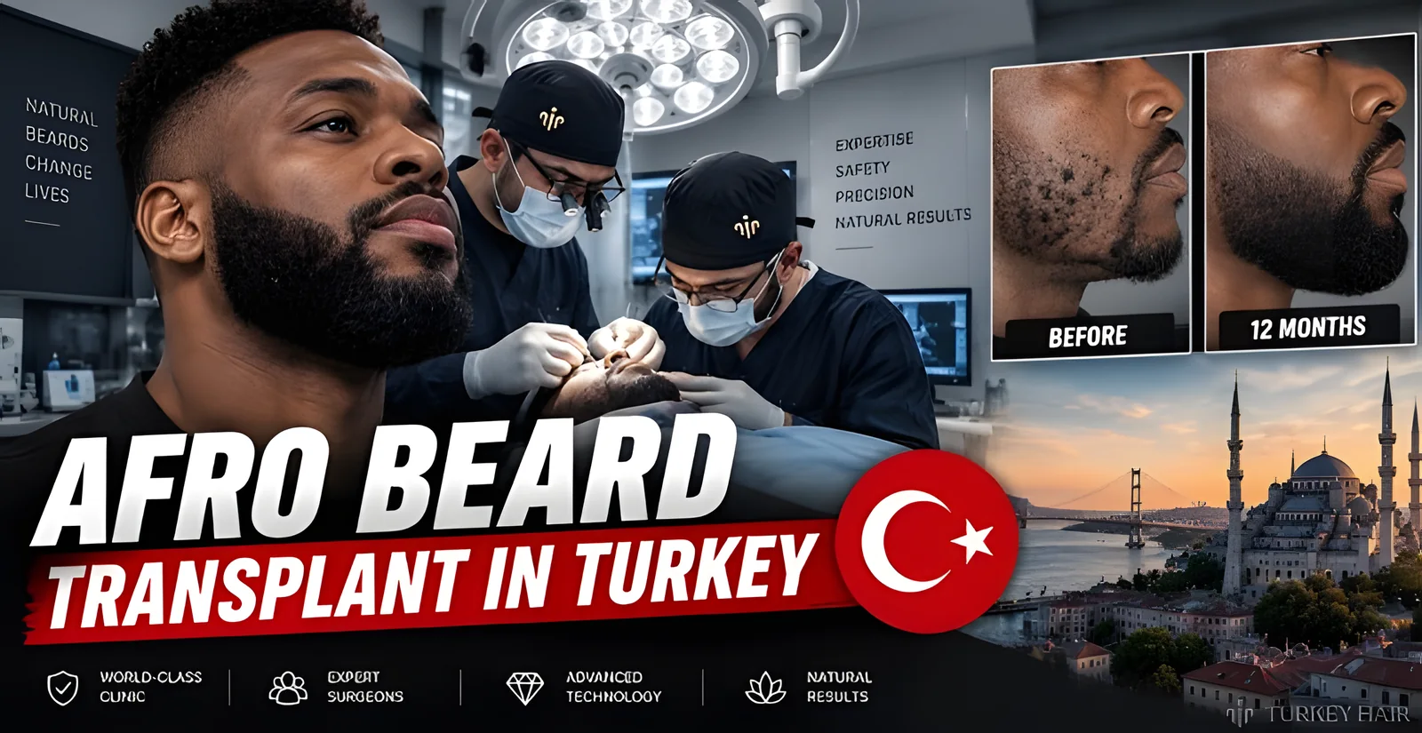 Afro Beard Transplant in Turkey: Cost, Grafts & Results