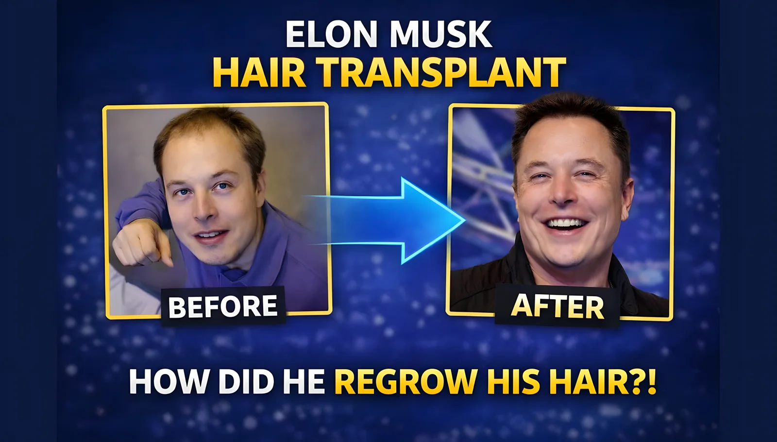 Elon Musk Hair Transplant: Did He Really Regain His Hair? Before and After Analysis