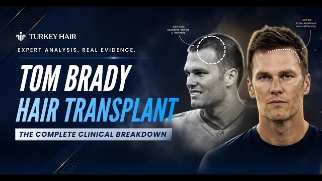 Tom Brady Hair Timeline & Before-After Analysis