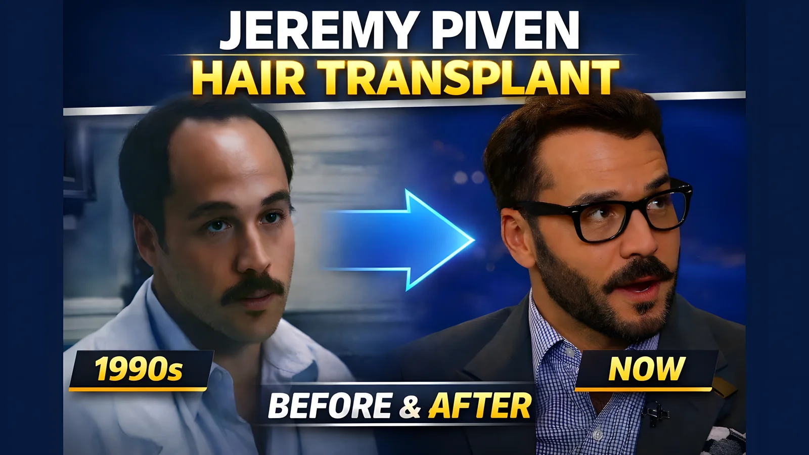 Did Jeremy Piven really get a hair transplant?