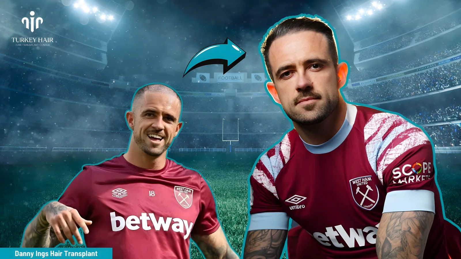 Let's Discover Succesfull Striker Danny Ings' Hair Transplant 2023 | #turkeyhairtransplant