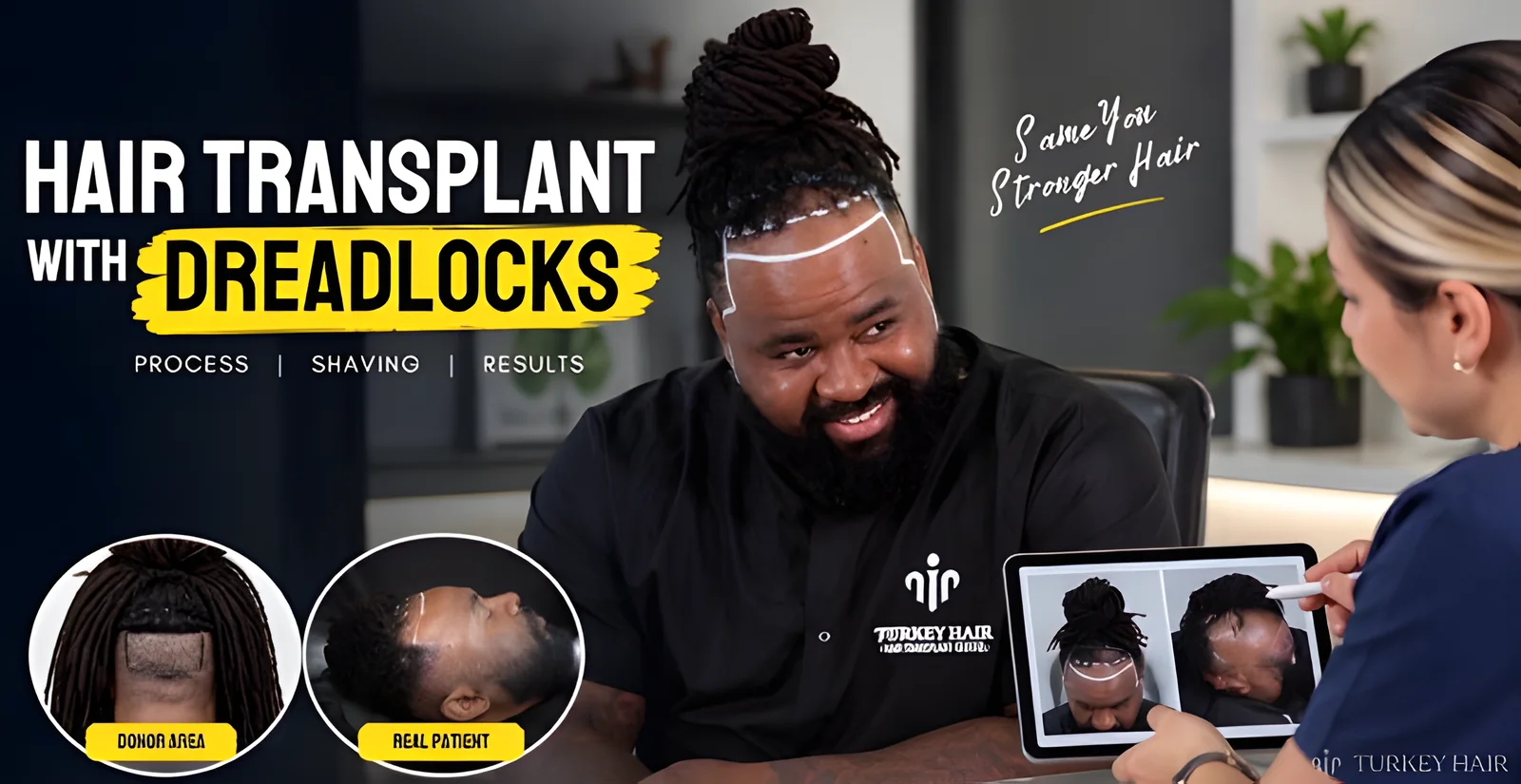 Hair Transplant with Dreadlocks: Cost, Shaving, FUE & Results