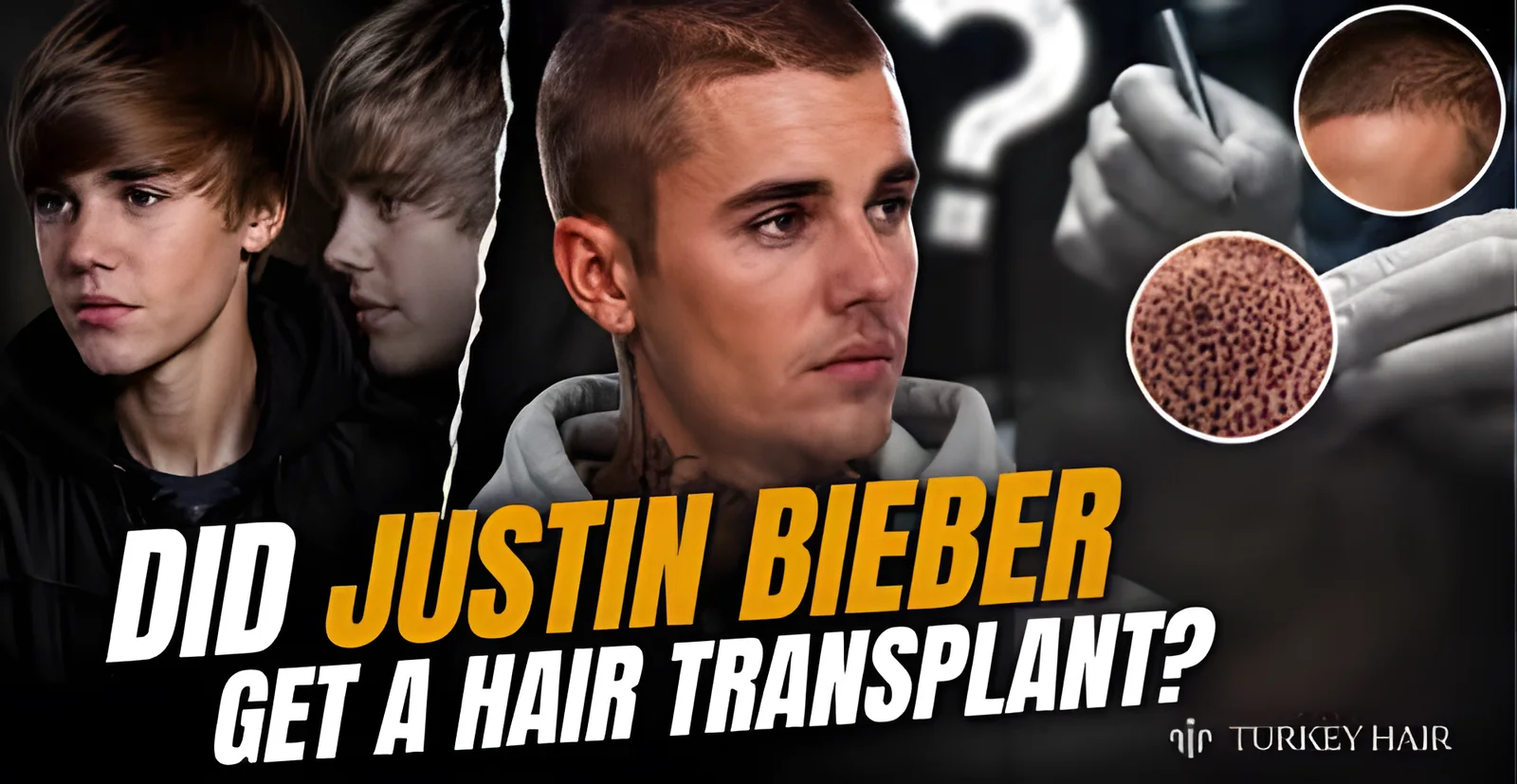 Justin Bieber Hair Transplant Rumors: Expert Look at His Hairline