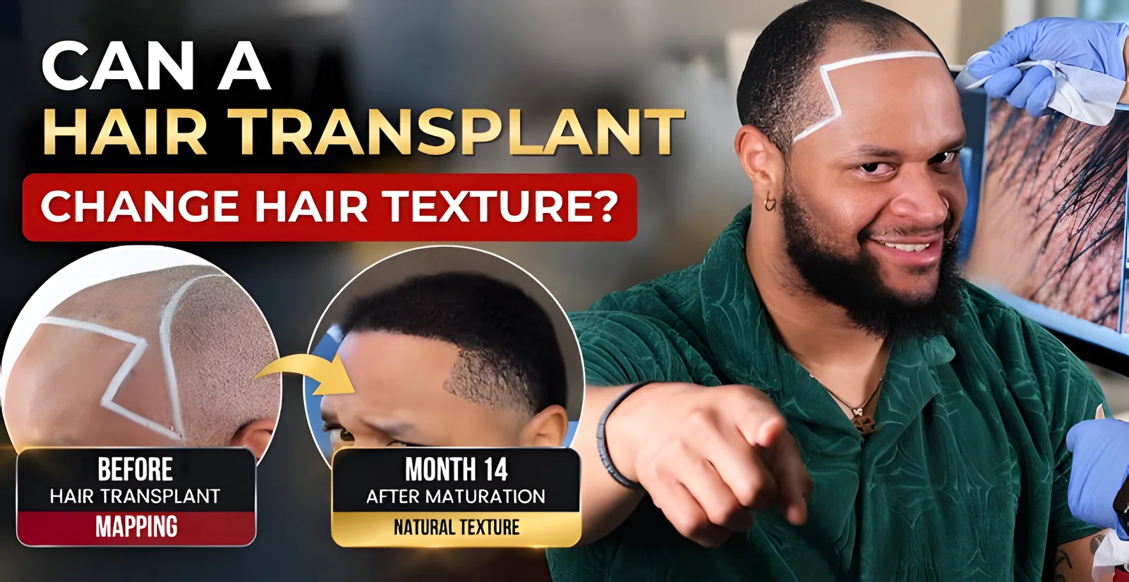 Can a Hair Transplant Change Hair Texture? What You Need to Know
