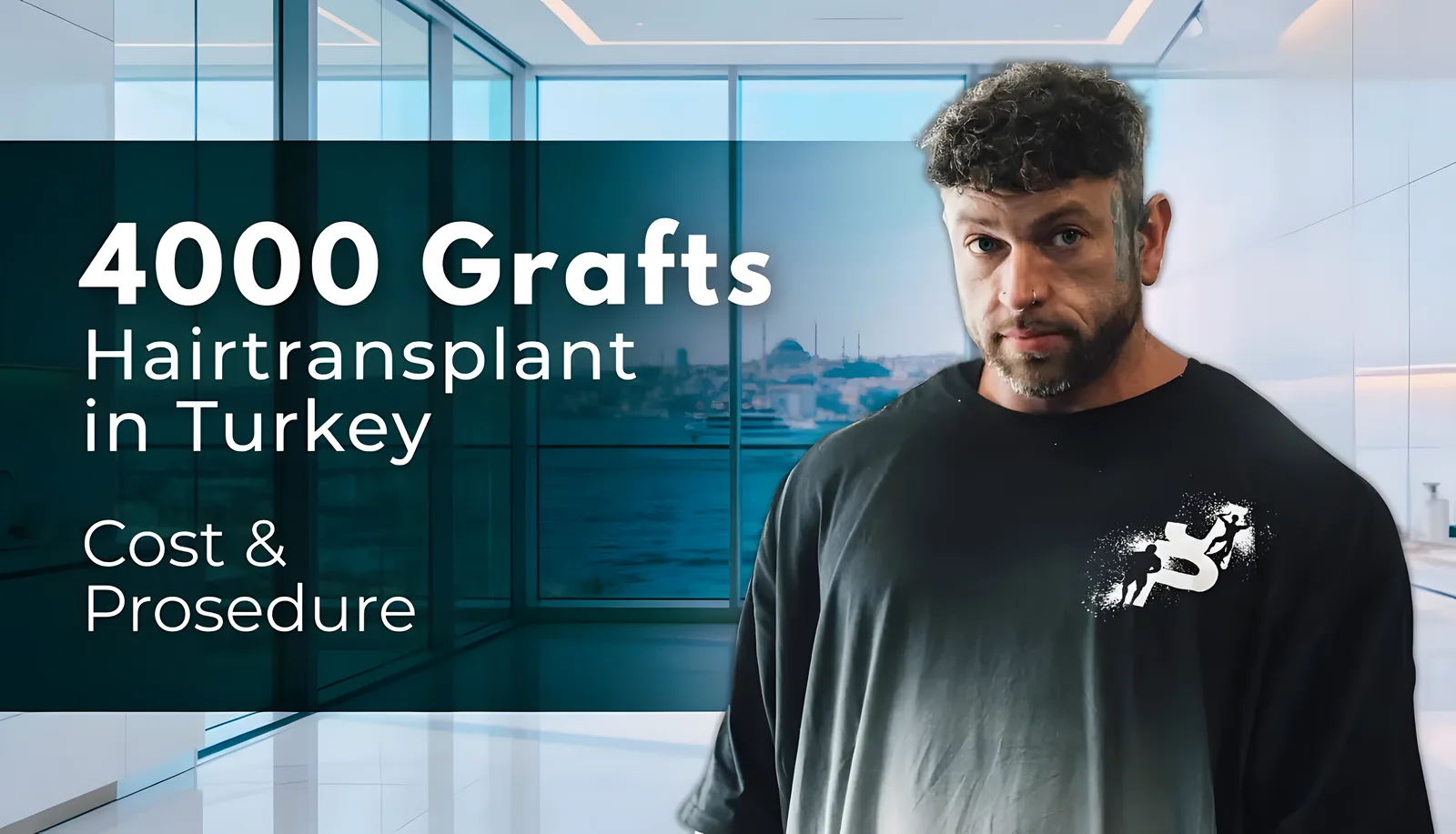 4000 Grafts Hair Transplant | Before & After Results & Hairline Transformation