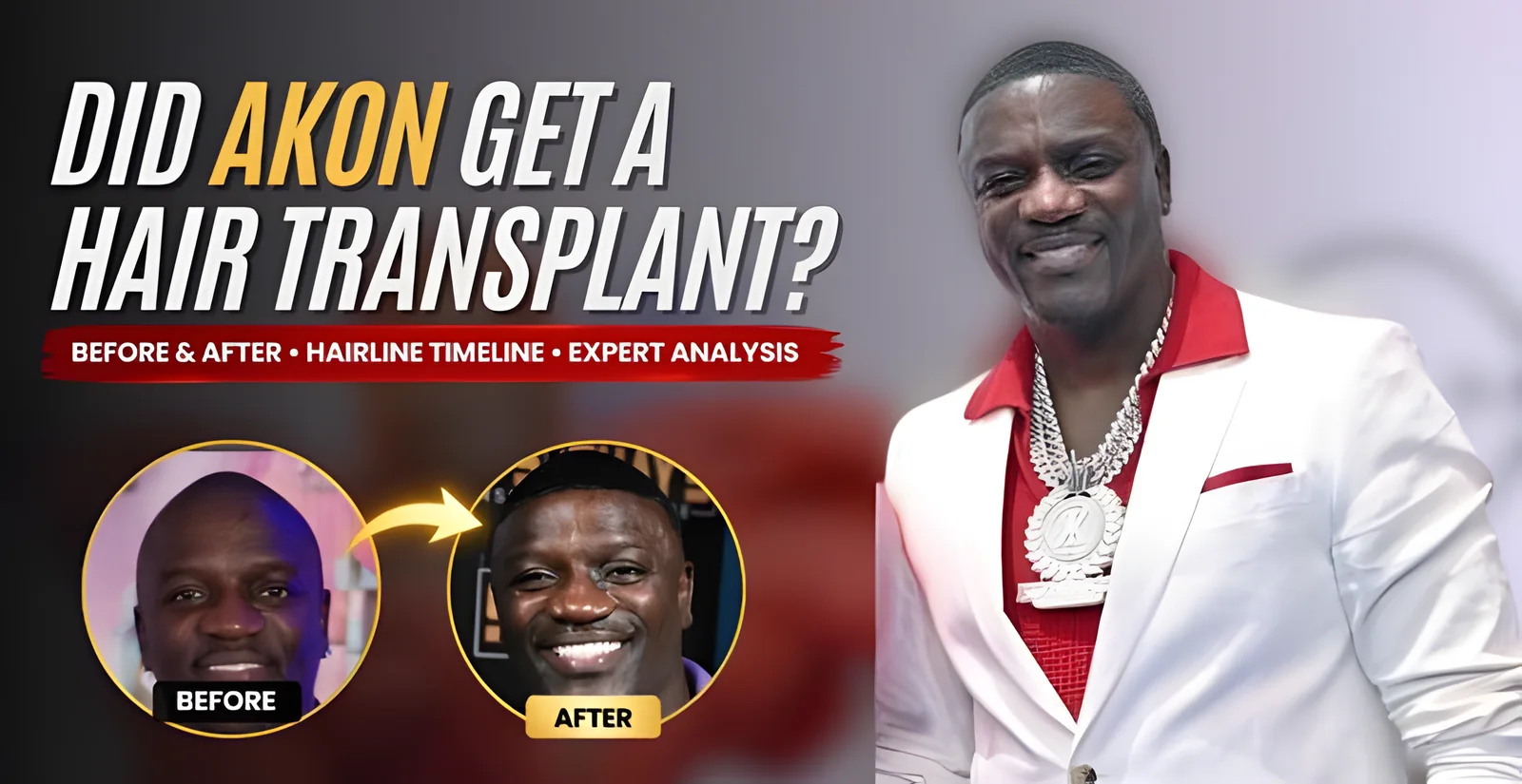 Did Akon Get a Hair Transplant? Before & After Analysis | FUE or DHI?