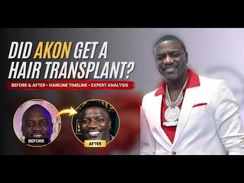 Did Akon Get a Hair Transplant? Before & After Analysis | FUE or DHI?
